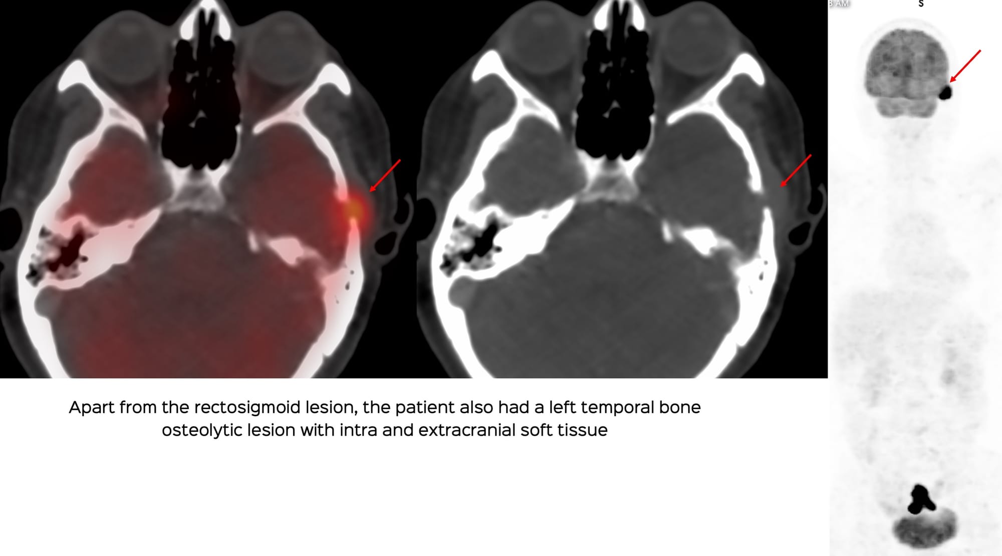 Case 140: Temporal Bone Biopsy