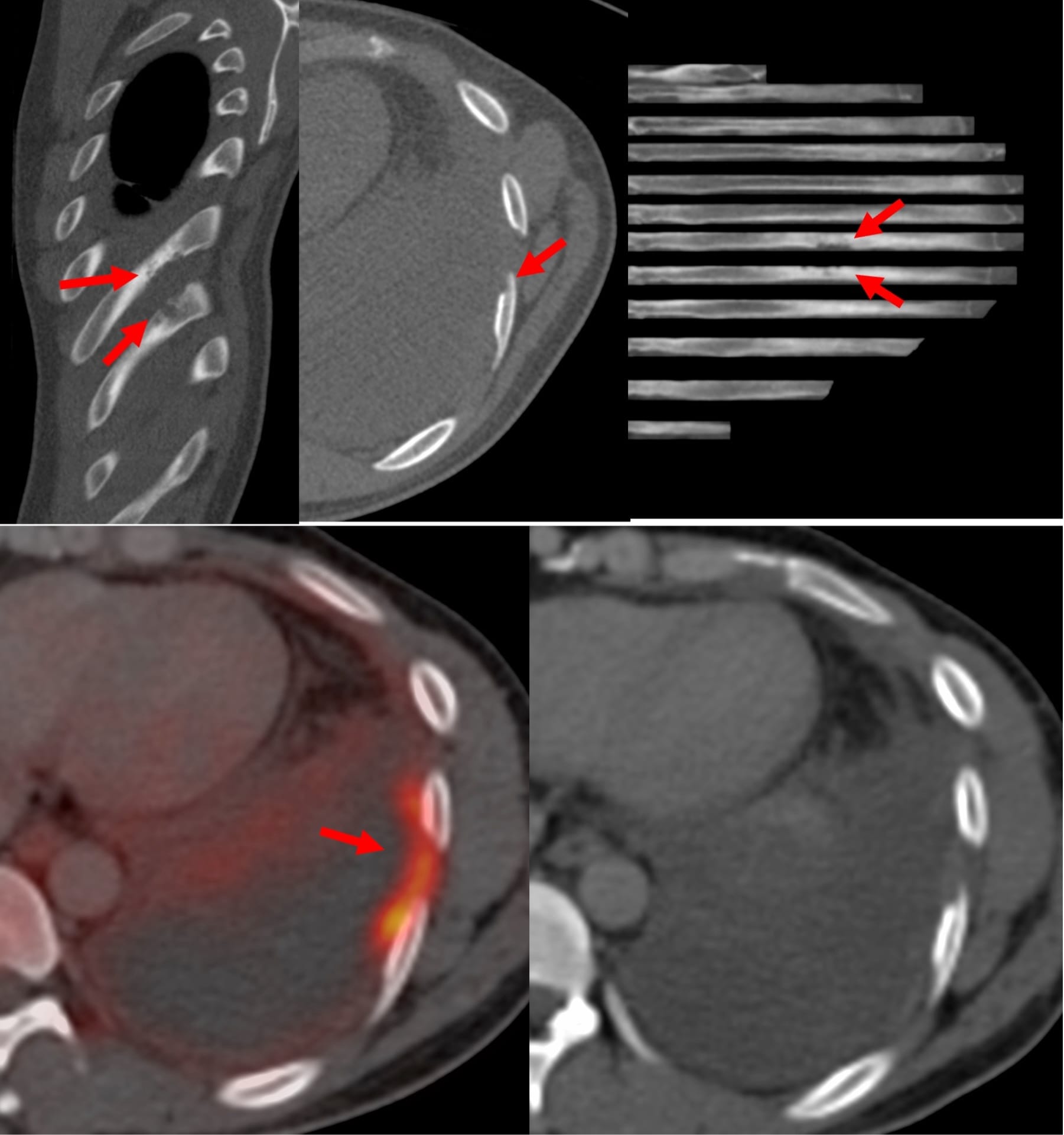 Case 139: Transpleural Collection Biopsy of a Chest Wall Lesion