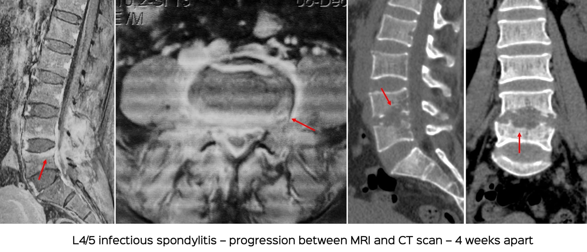 Snippet: Why Every Infectious Spondylitis Needs a Biopsy - Three Recent Unusual Spine Infections