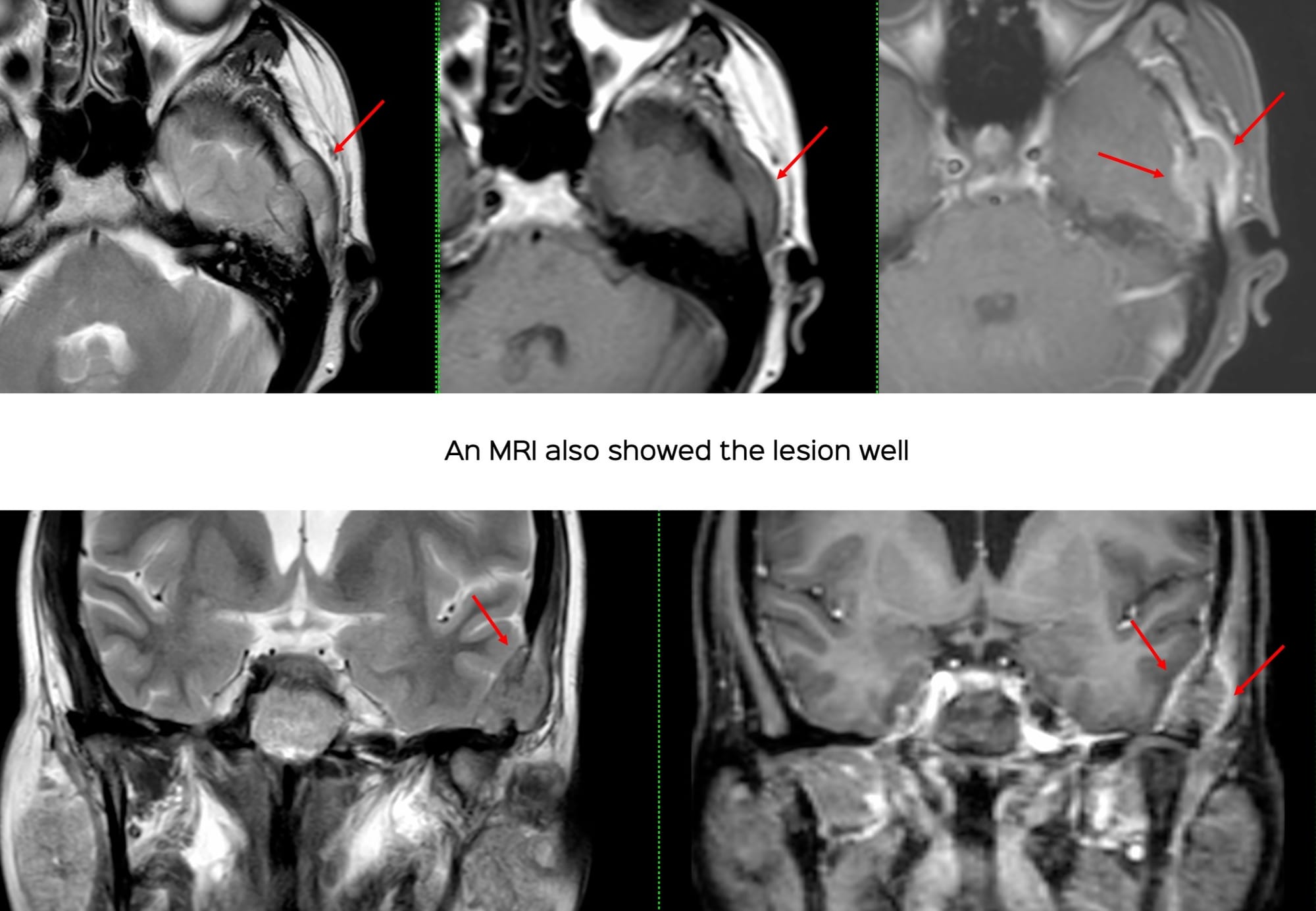 Case 140: Temporal Bone Biopsy