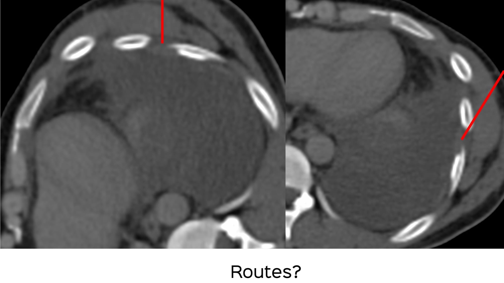 Case 139: Transpleural Collection Biopsy of a Chest Wall Lesion