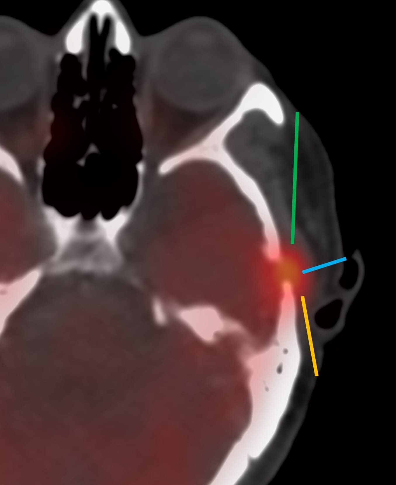 Case 140: Temporal Bone Biopsy