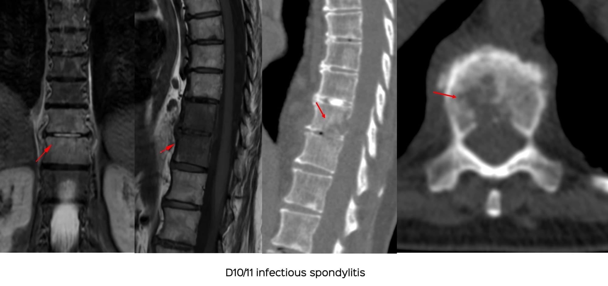 Snippet: Why Every Infectious Spondylitis Needs a Biopsy - Three Recent Unusual Spine Infections