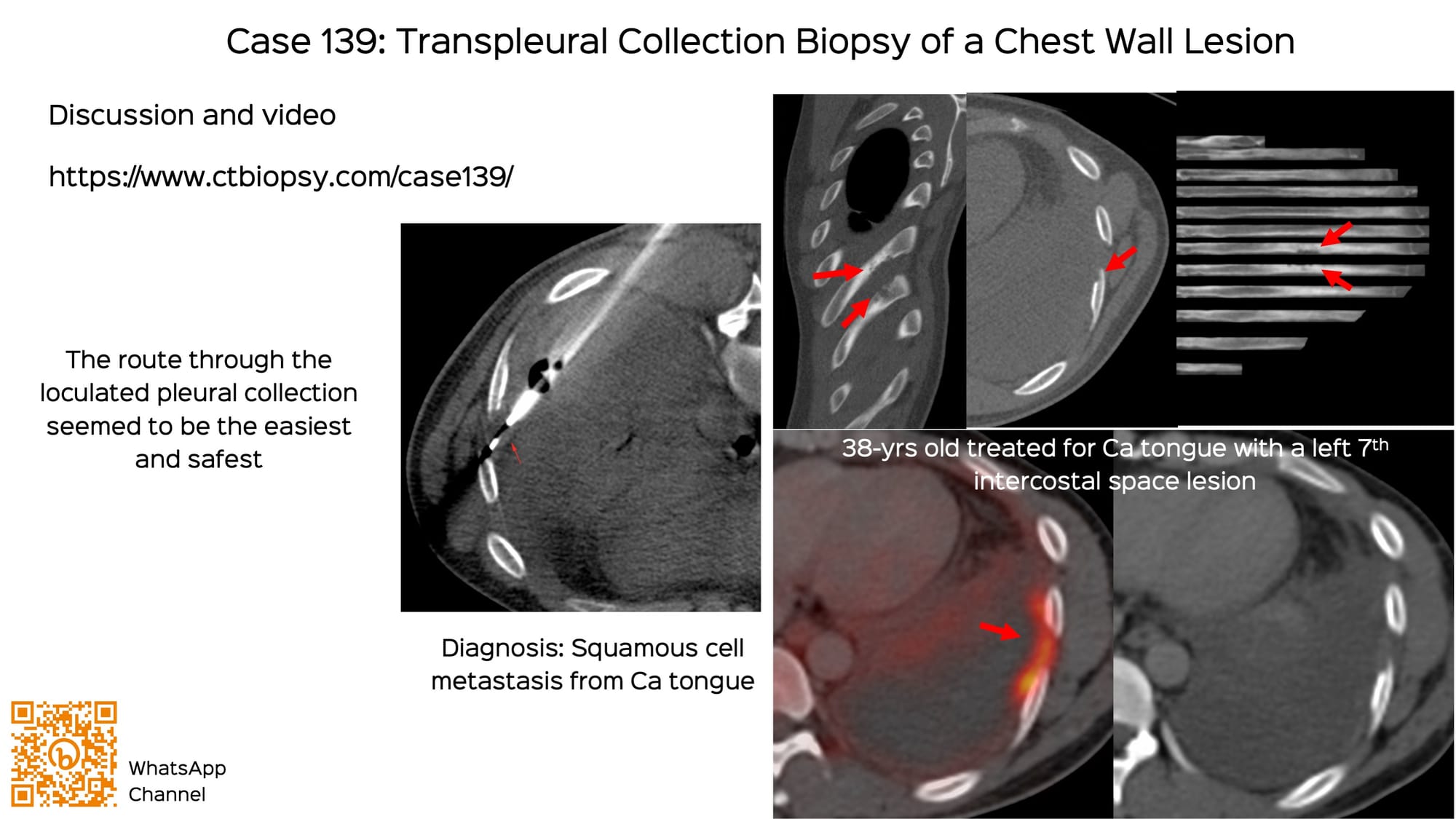 Case 139: Transpleural Collection Biopsy of a Chest Wall Lesion