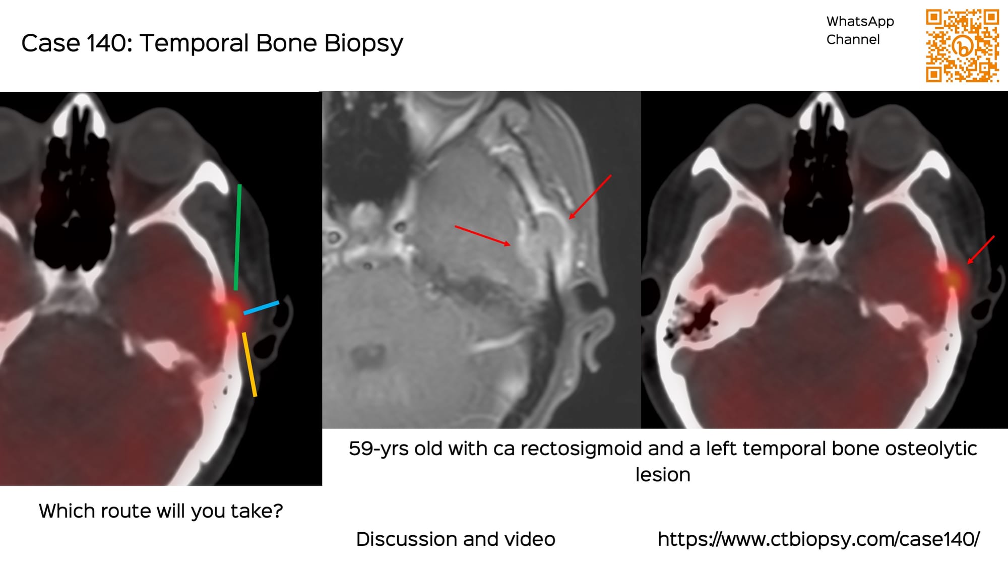 Case 140: Temporal Bone Biopsy