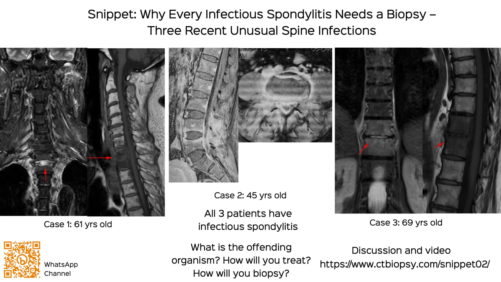 Snippet: Why Every Infectious Spondylitis Needs a Biopsy - Three Recent Unusual Spine Infections