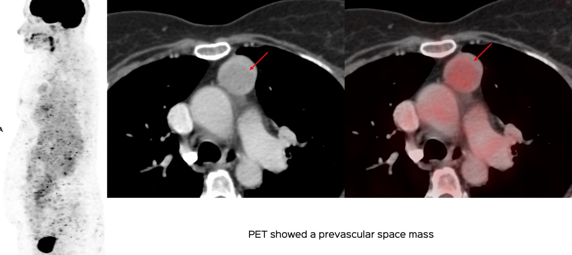 Case 141: Thymic Mass Biopsy, Seeding Issues, etc