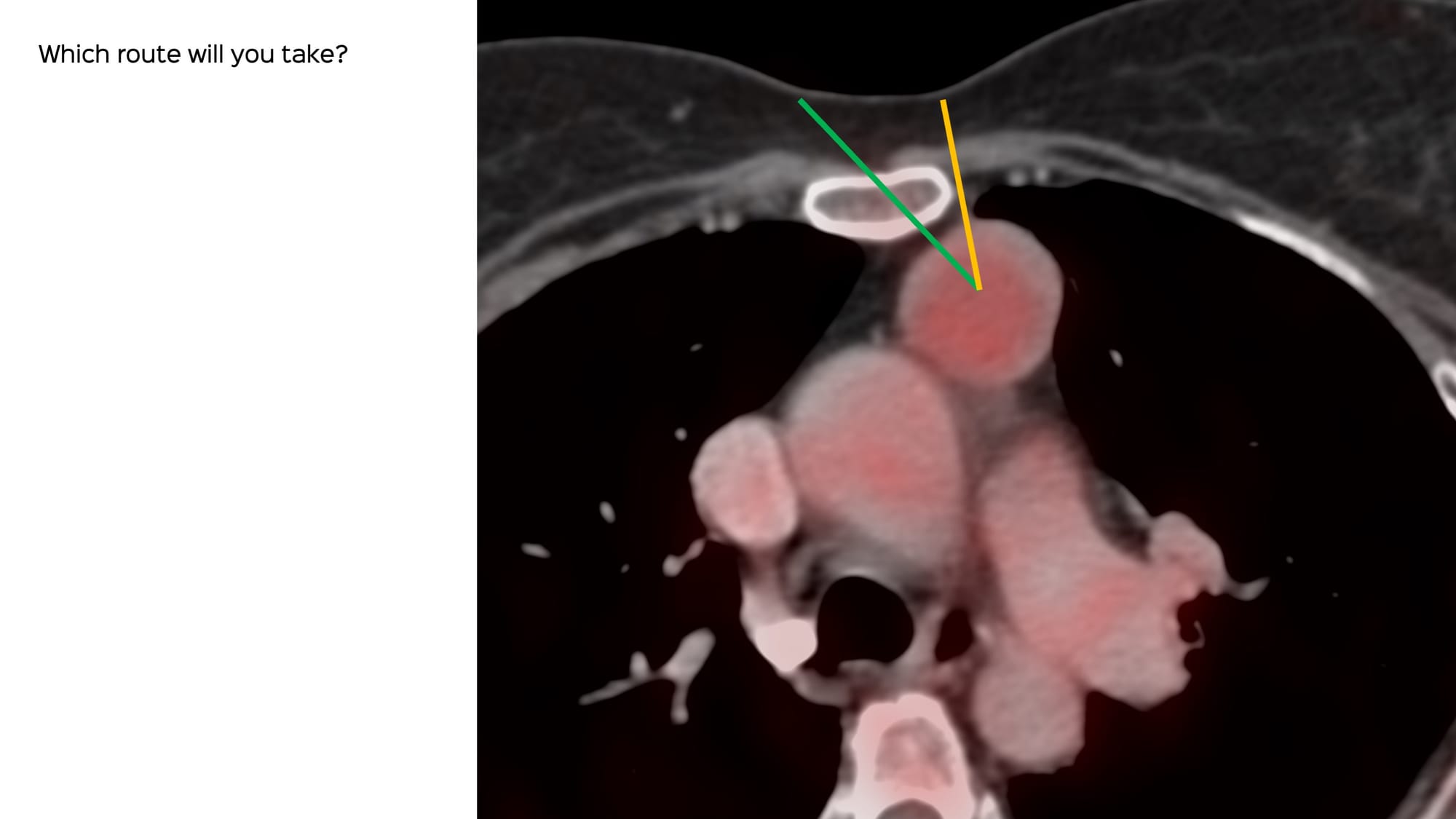 Case 141: Thymic Mass Biopsy, Seeding Issues, etc