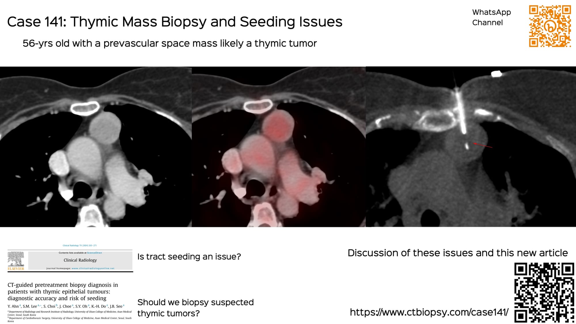 Case 141: Thymic Mass Biopsy, Seeding Issues, etc