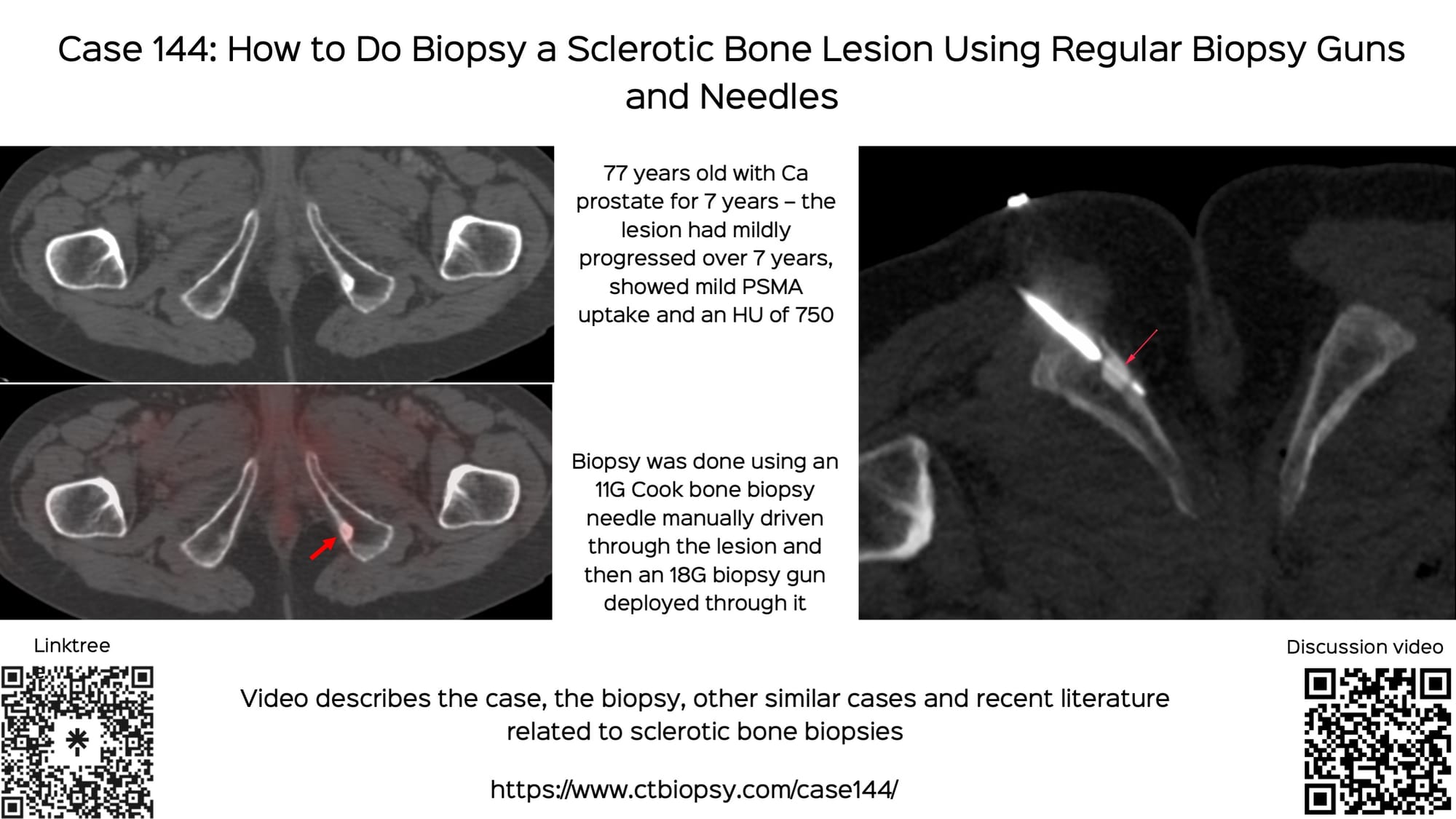 Case 144: How to Biopsy a Sclerotic Bone Lesion Using Regular Biopsy Guns and Needles