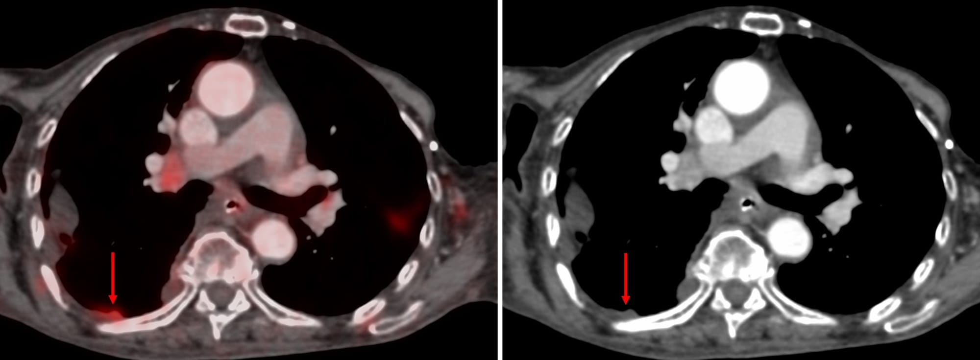 Case 143: Long Parallel Approach to Small Pleural Lesions