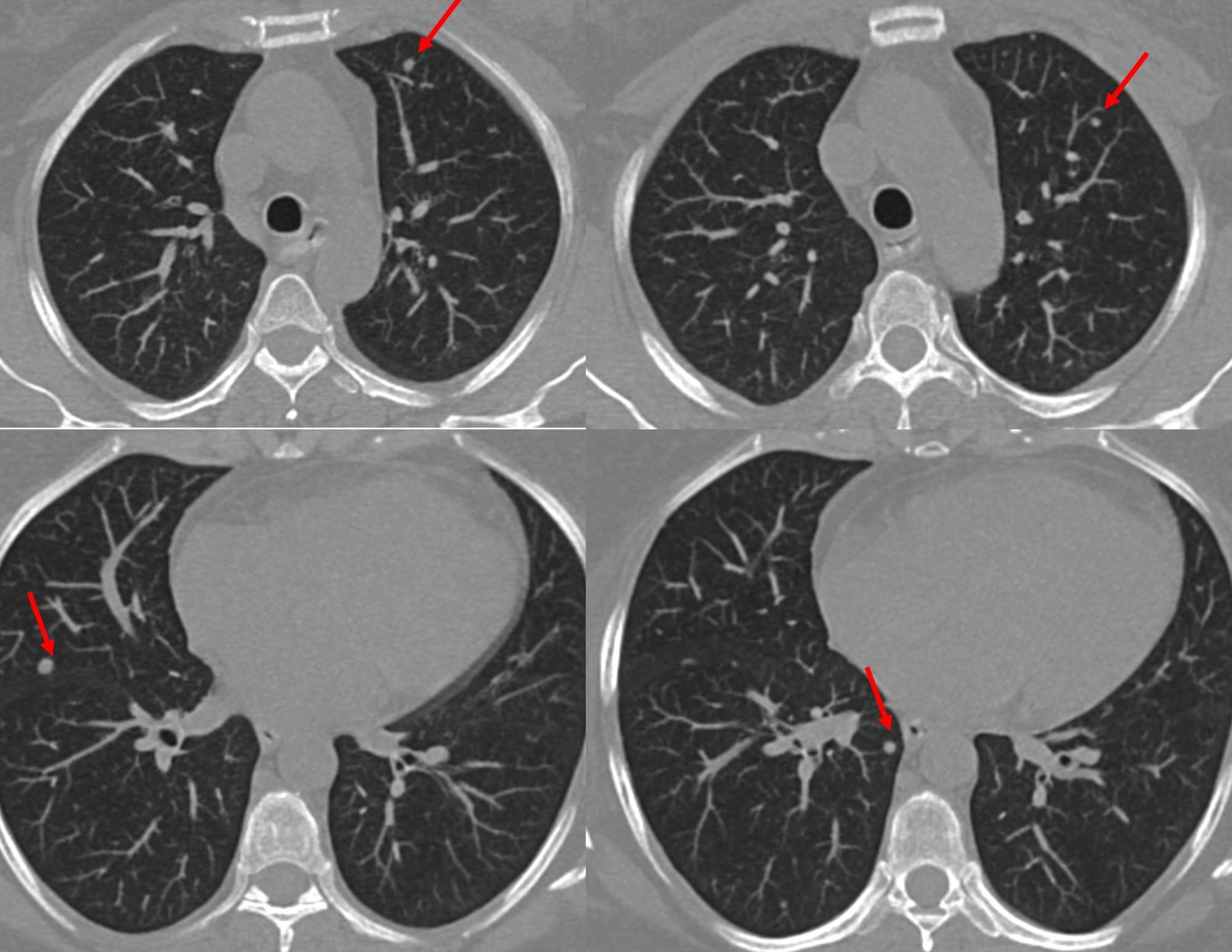 Case 142: Sub 5 mm Lung Nodule Biopsy