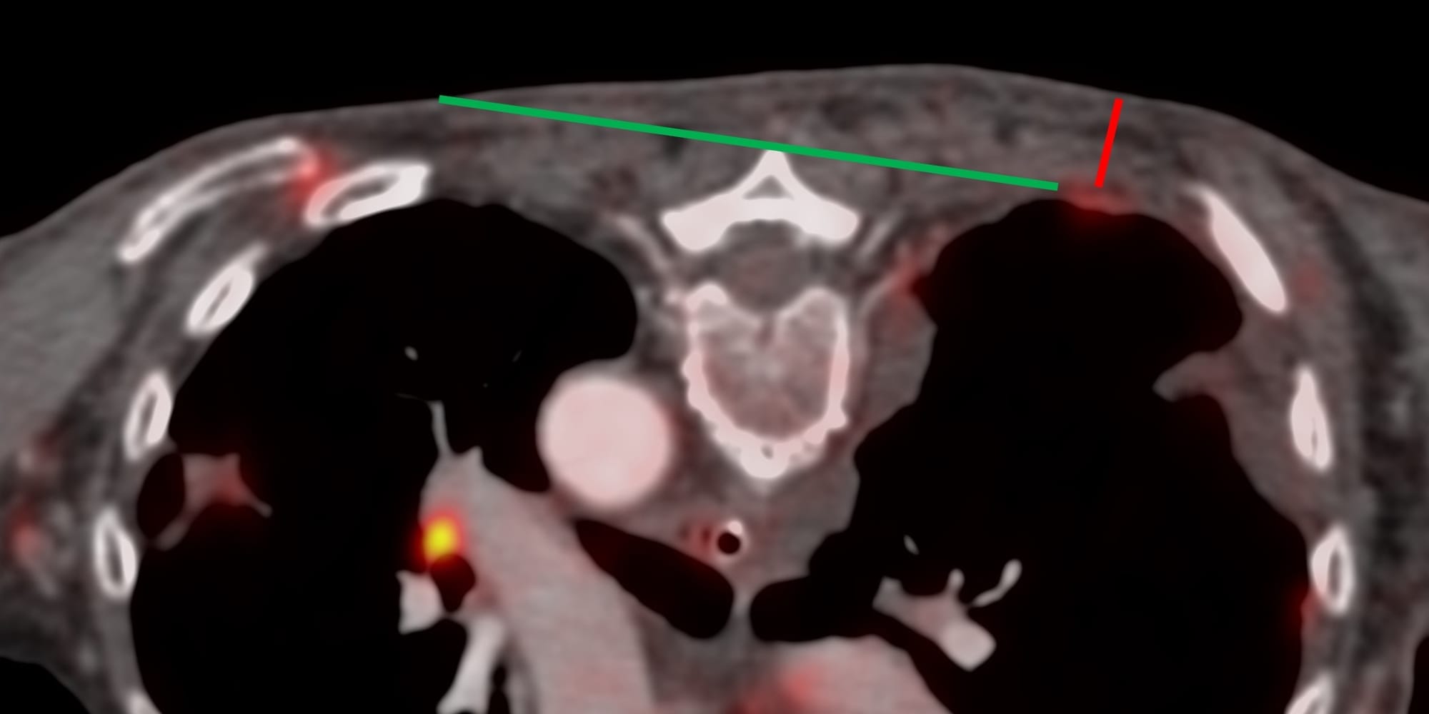 Case 143: Long Parallel Approach to Small Pleural Lesions