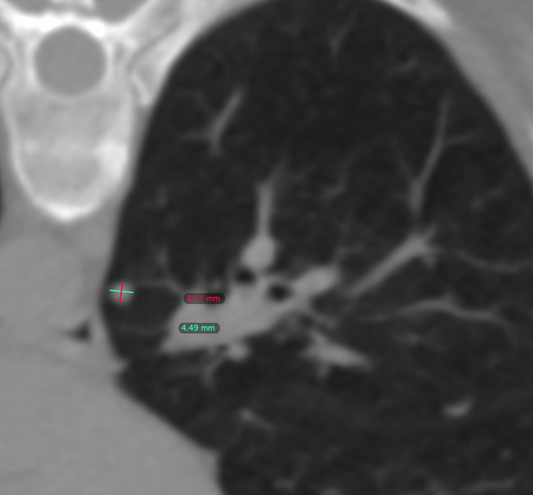 Case 142: Sub 5 mm Lung Nodule Biopsy
