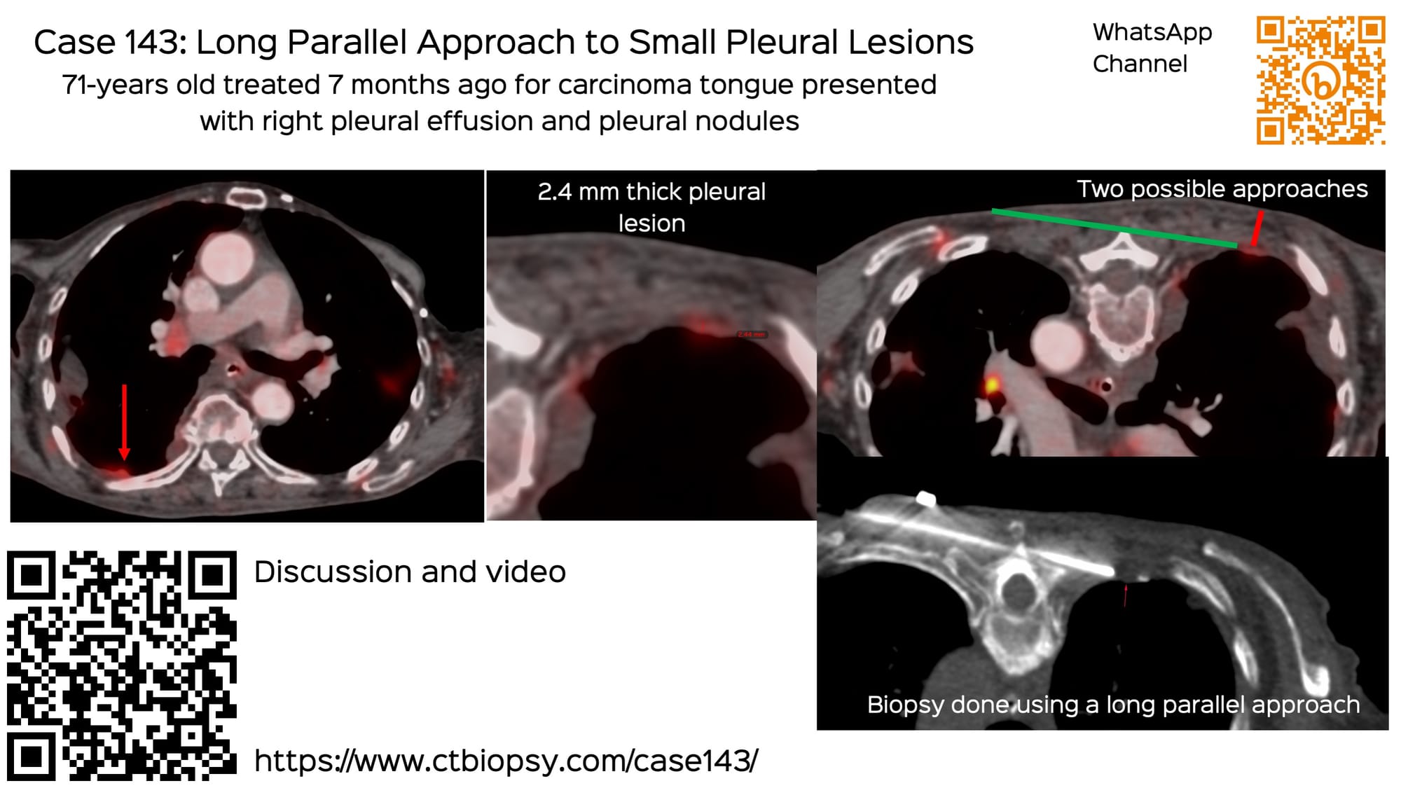Case 143: Long Parallel Approach to Small Pleural Lesions