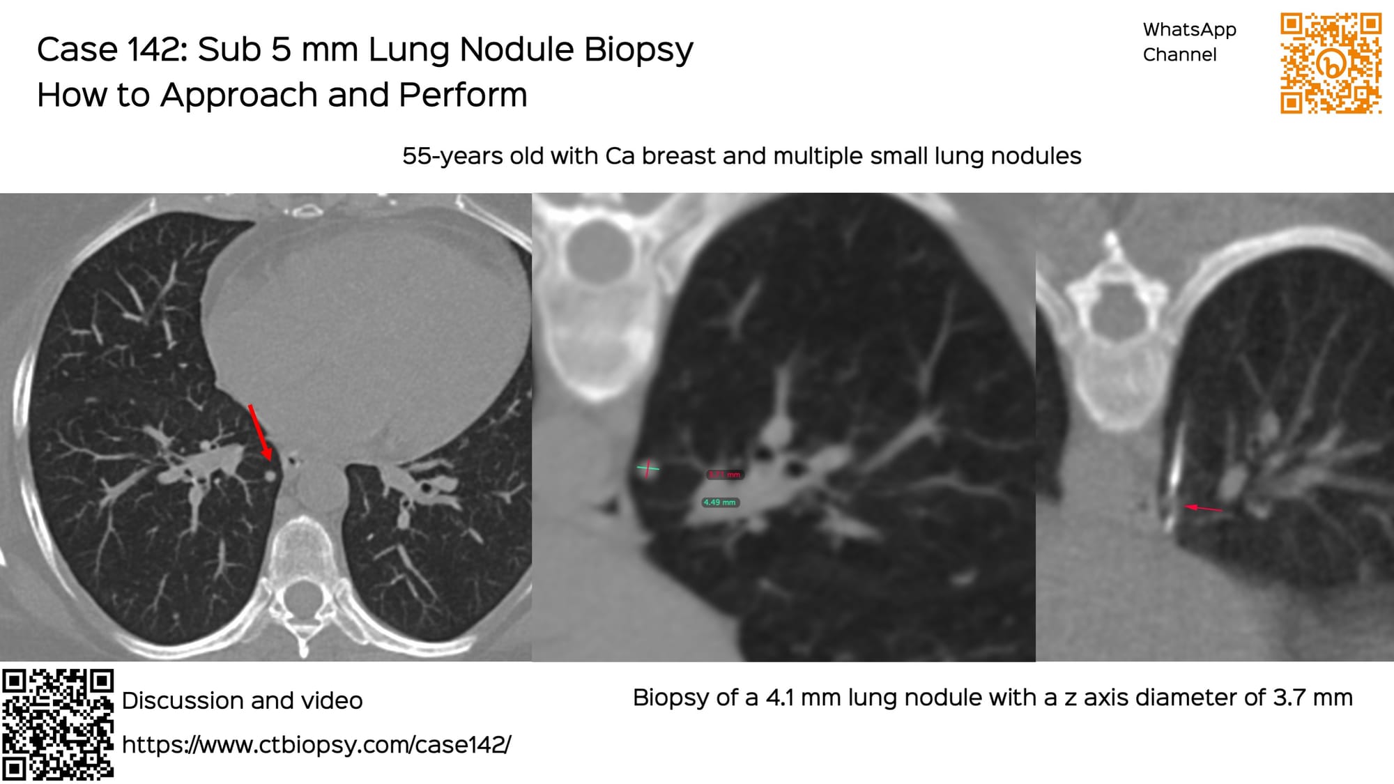 Case 142: Sub 5 mm Lung Nodule Biopsy