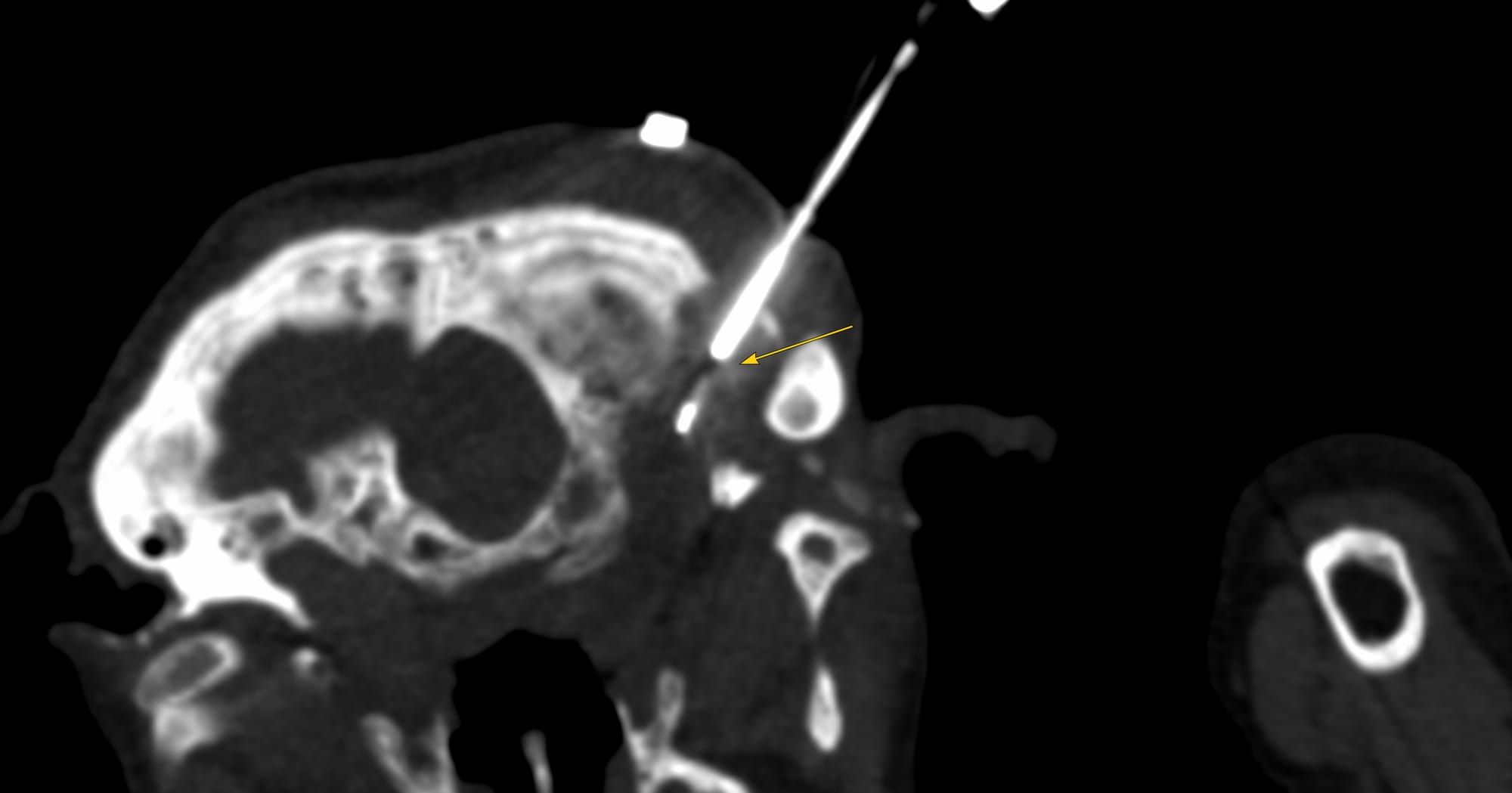 Case 168: Occipital Bone Osteolytic Lesion Biopsy