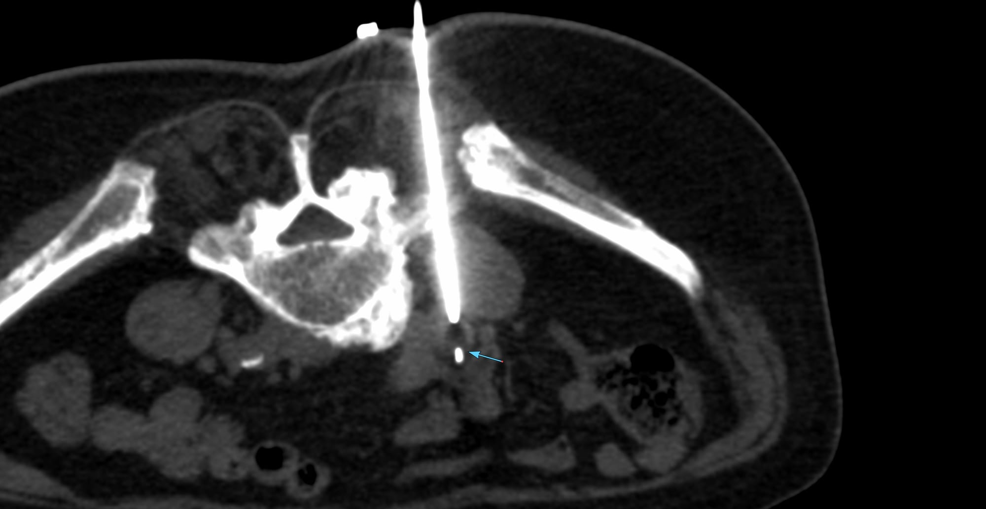 Case 169: Common Iliac Node Biopsy - Posterior Transiliotransverse Ligament Approach
