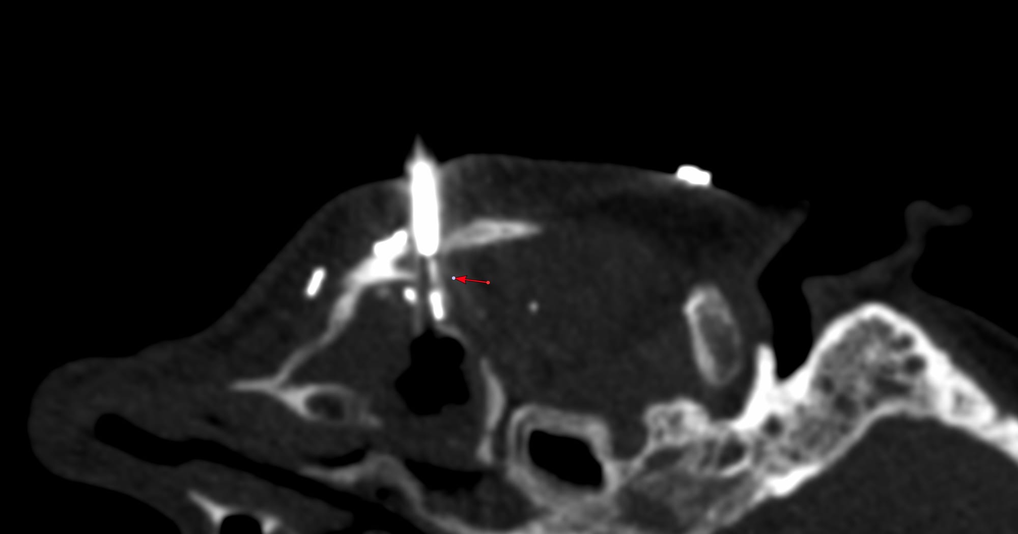 COD 127 - Maxillary Sinus Biopsy