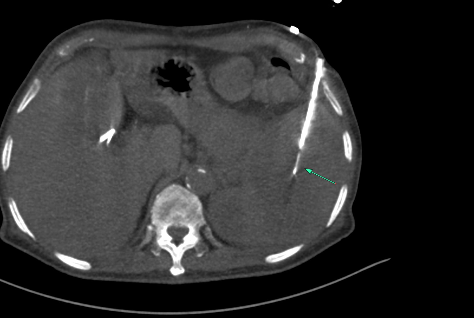 Case 171 - Splenic Mass Biopsy