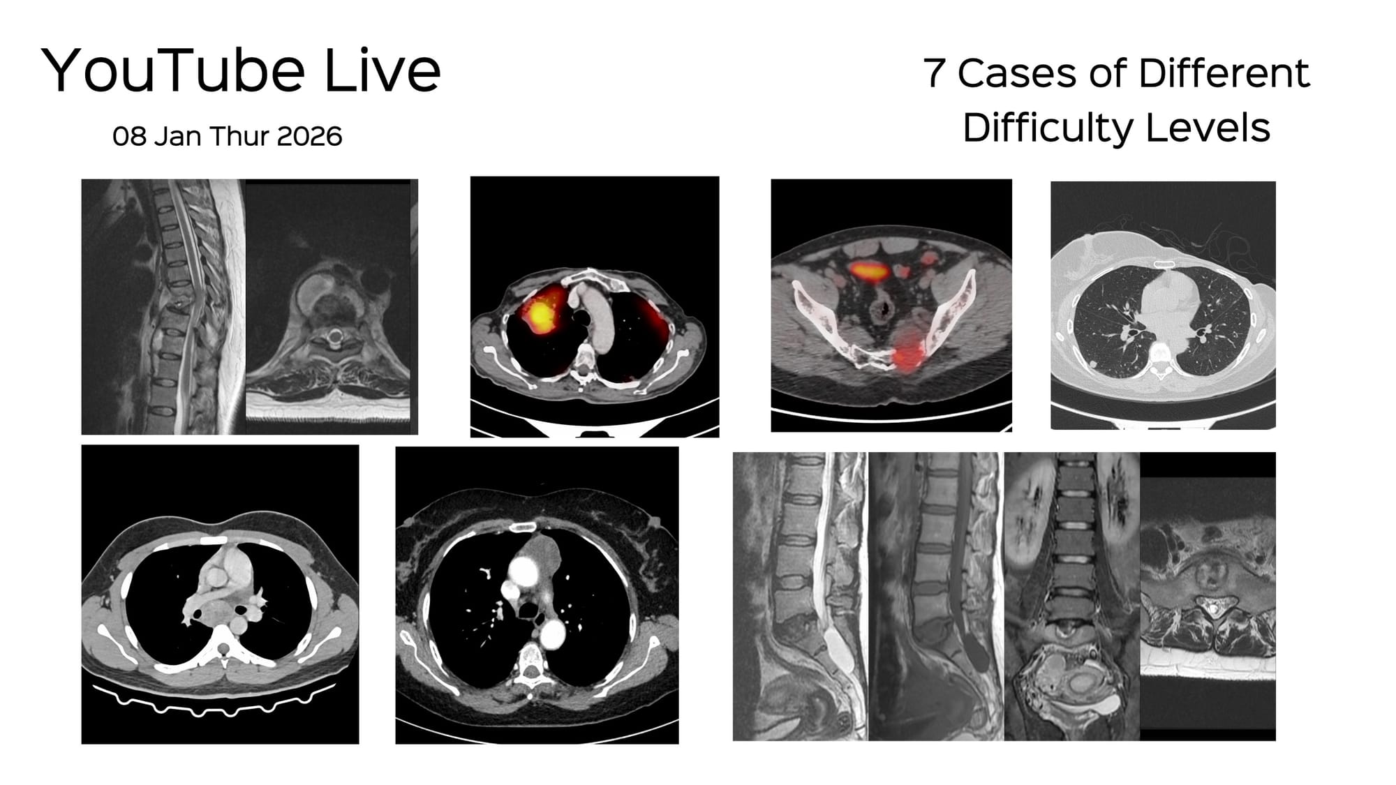 YouTube Live Session - CT Guided Biopsy Cases from December 2025