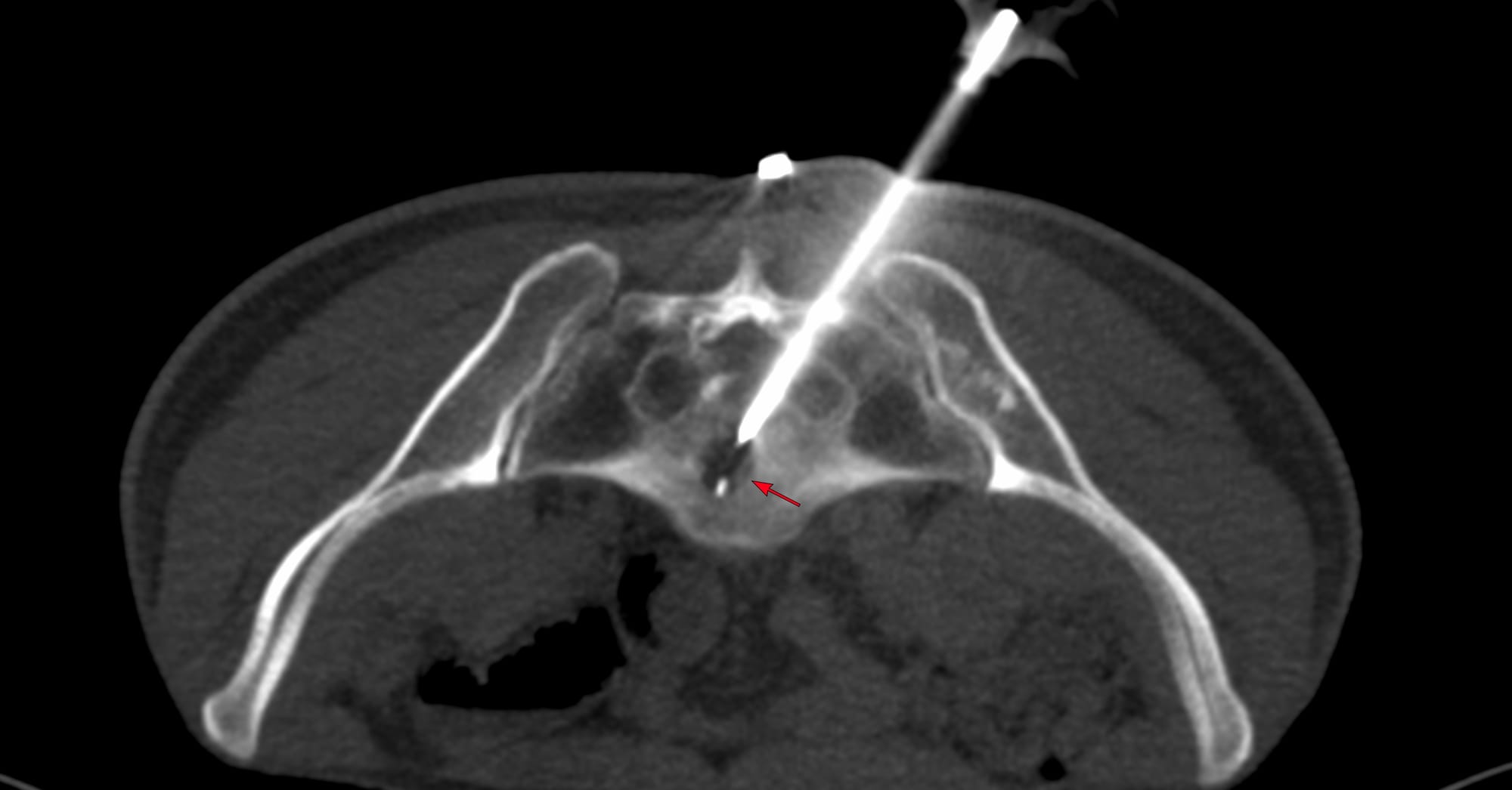 Case 175 - Transsacral Approach for an S1 Lesion Biopsy