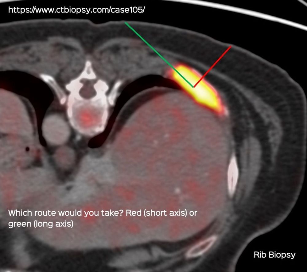 Case 105 Rib Lesion Biopsy Along the Long Axis