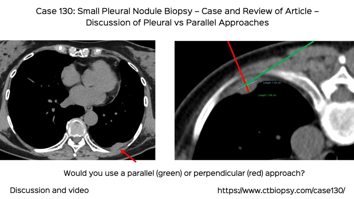 Case 130 Small Pleural Nodule Biopsy Case and Article Review