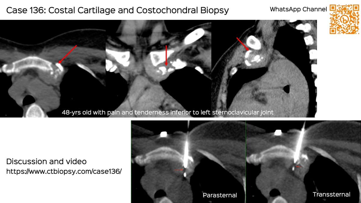 Case 137: Prevascular Space Mediastinal Lesion for Biopsy - What is Your Approach?