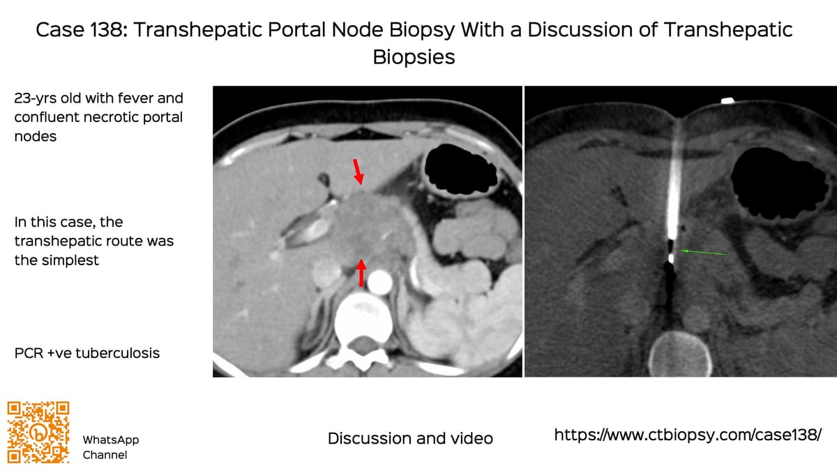 Snippet: Why Every Infectious Spondylitis Needs a Biopsy - Three Recent Unusual Spine Infections