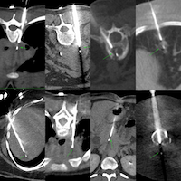 Case 143: Long Parallel Approach to Small Pleural Lesions