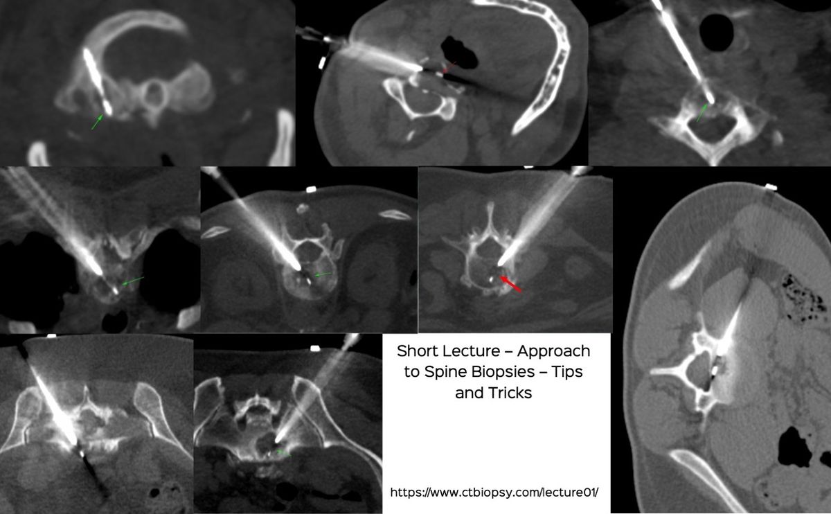 Lecture - CT Guided Spine Biopsies