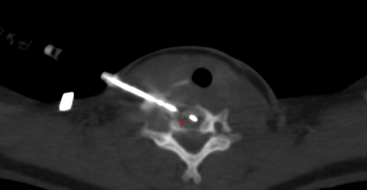Case of the Day 100 - 2025 09 10 - T2 Dark Thoracic Spinal Vertebral Lesion - Transpedicular Biopsy